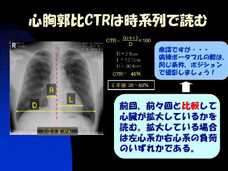 透析の心胸郭比についてです。   ctrは透析 